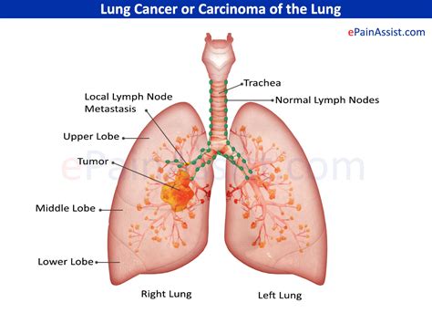 Infection with the human immunodeficiency virus (hiv). Lung Cancer or Carcinoma of the Lung « MedicineBTG.com