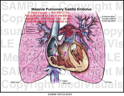 Massive Pulmonary Saddle Embolus Medical Illustration