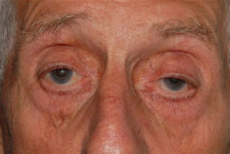 Ptosis Drooping Of The Upper Eyelid Bopss