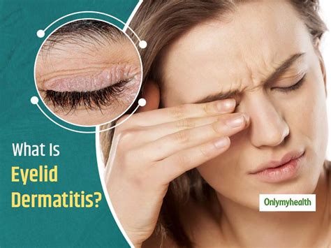 Eyelid Dermatitis Or Dry Eyelids Is A Common Problem Tackle It With