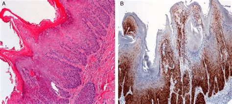 Although Diagnosed As Differentiated Vulvar Intraepithelial Neoplasia