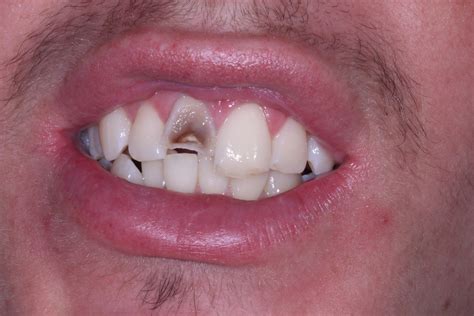 Broken Front Tooth Essex London Viva Dental Studio