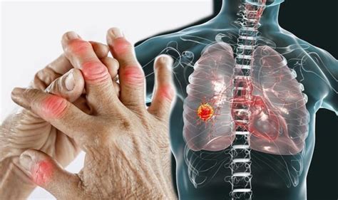 Lung Cancer Finger Clubbing Could Indicate Your Risk Of The Disease