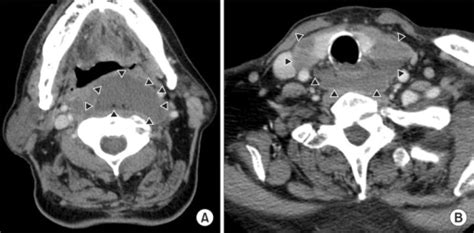 Contrast Enhanced Ct Scan Of The Neck Retropharyngeal Open I
