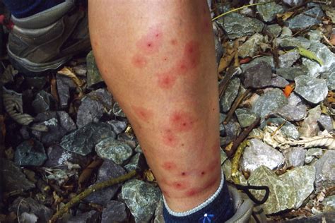 My Bug Bitesjust The Lower Leg Though Flickr Photo Sharing