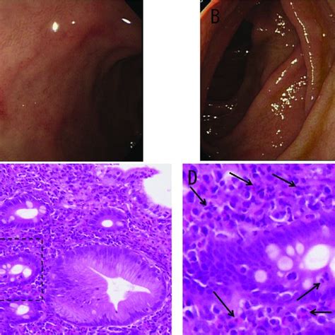 Upper Gastrointestinal Endoscopy Findings And Histological Findings Of