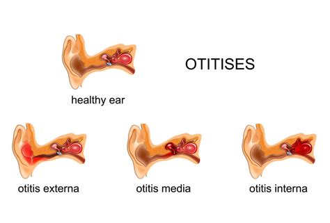 How To Use Essential Oils To Soothe Otitis Pacific Scents