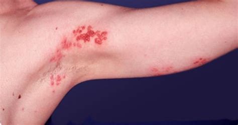 Moderate Case Of Shingles On Upper Arm Post Herpetic Neuralgia Phn