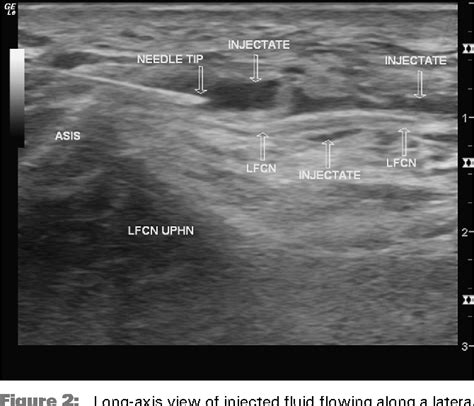 Figure 2 From Ultrasound Guided Percutaneous Neuroplasty Of The Lateral