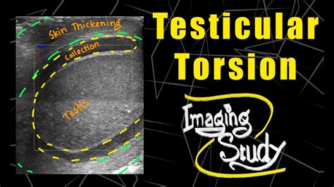 Testicular Torsion Ultrasound Doppler Case Youtube