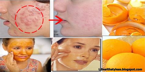 Homemade Orange Peel Face Mask For Pimples And Acne Scars Life With