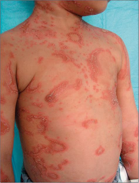 Picture Of The Month—quiz Case Dermatology Jama Pediatrics Jama