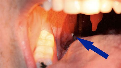 Oral Thrush Tonsils Shop Discounted Save 69 Jlcatjgobmx