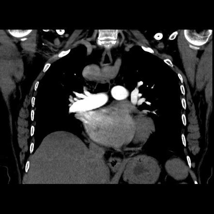 Right Sided Aortic Arch With Kommerell S Diverticulum Radiology Case