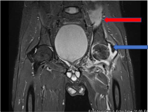 Mri Of The Left Hip Demonstrating Synovial Thickening Blue And