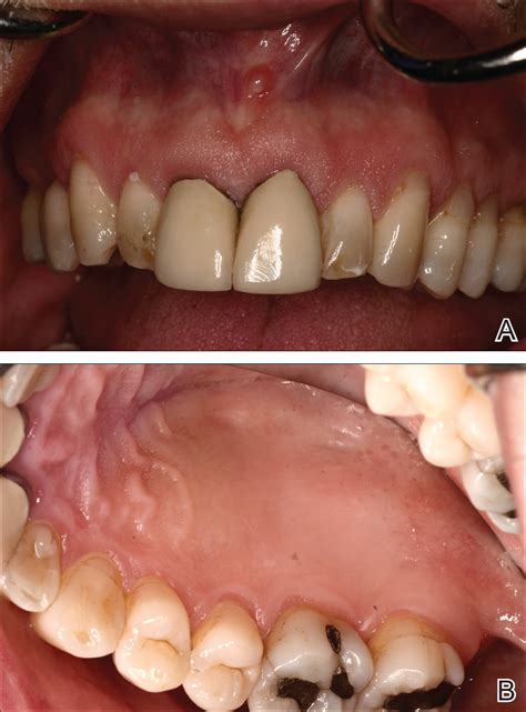 Resolution Of Psoriatic Lesions On The Gingiva And Hard Palate