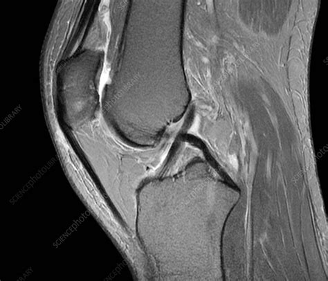 What Does A Normal Knee Mri Look Like