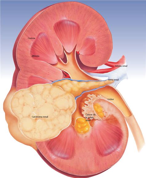 What Are The Different Types Of Renal Tumor With Pictures Kulturaupice