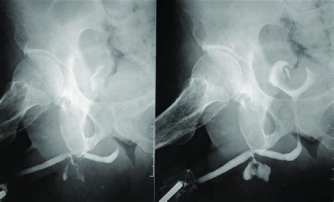 Retrograde Urethrogram Showing The Urethral Fistula Arising From