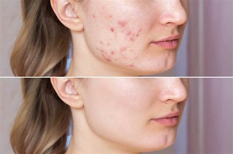 Premium Photo Cropped Shot Of A Young Womans Face Before And After Acne Treatment On Facez