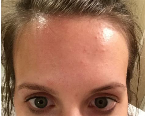 How I Cleared My Tiny Bumps On Forehead Once For All Forehead Bumps Forehead Acne Small