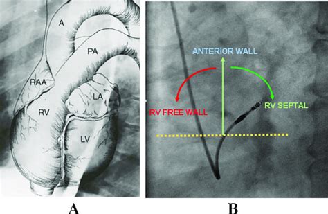 A Anatomy Of Different Cardiac Chambers In Left Anterior Oblique View