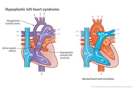 Cardiology Hypoplastic Left Heart Syndrome Hd