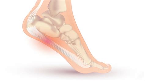Fascite Plantare Cause Sintomi E Trattamenti