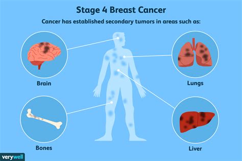 What Happens When Breast Cancer Spreads To The Brain 2022