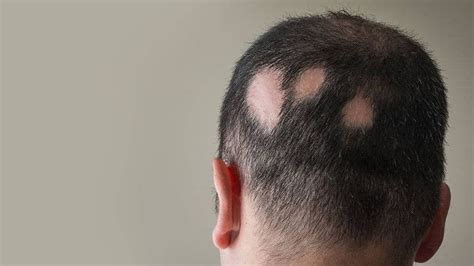 Alopecia Areata Cyprus Dermatology Clinic