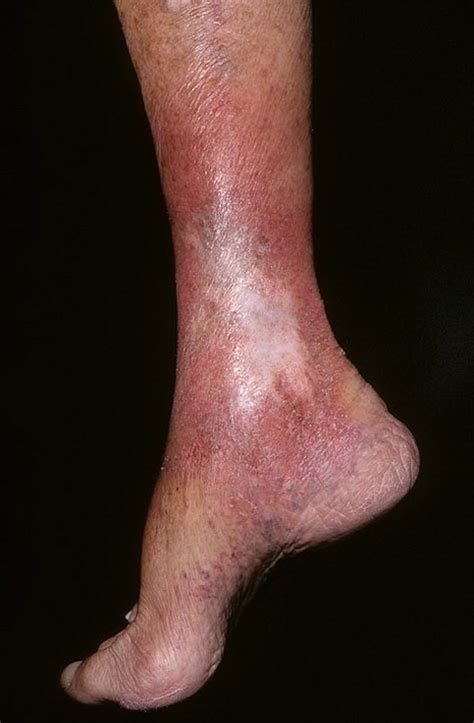 Venous Eczema On Legs Pictures 174 Photos And Images