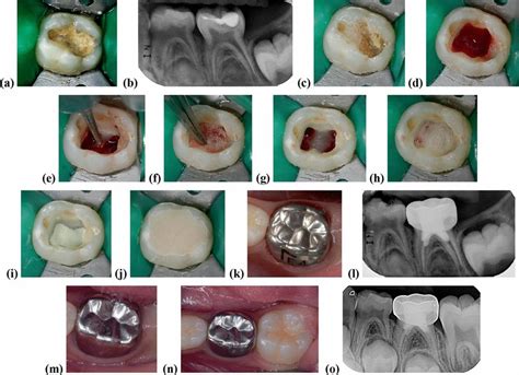 Mta Pulpotomy In A Primary Lower Molar A Clinical Examination Showing