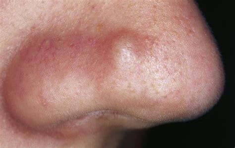 Bumps On Nose Causes Small Big Hard And Painful Skincarederm