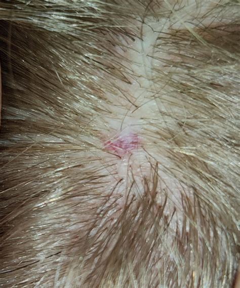 Found On My Scalp Hurts When Touched No Injuries Any Ideas What It