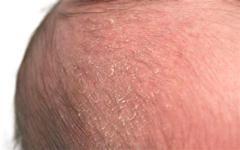 What To Use For Cradle Cap For Babies Armstrong Unclefor