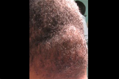 Folliculitis Scalp African American