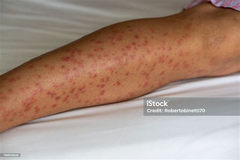 Skeeters Syndrome After Mosquitos Bite Stock Photo Download Image Now
