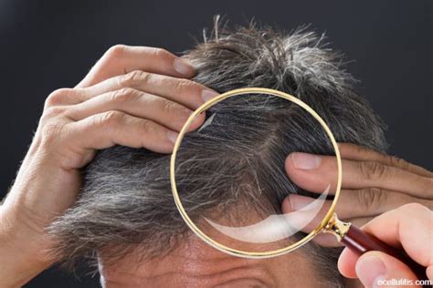 What Is Dissecting Cellulitis Of The Scalp Pcas