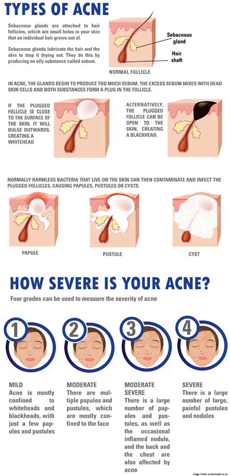What Is Acne Types Causes Signs Symptoms Treatment