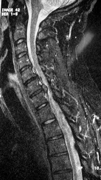 Sagittal Mri Of The Cervical Spine Confirming C67 Disc Extrusion