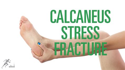 Calcaneus Stress Fracture Signs Symptoms And Treatment Options Youtube