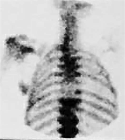 Bone Scan Of The Spine Showing An Increased Uptake In The Lower