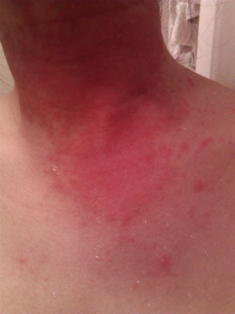 Allergic Reaction To Bactrim Pictures Photos