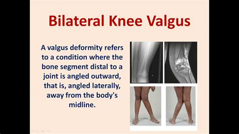 Knee Valgus Deformity Rheumatoid Knee Rheumatoid Valgus Knee
