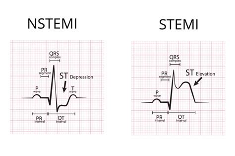 Atiologie, diagnose, therapie / h. Was ist ein NSTEMI-Infarkt?