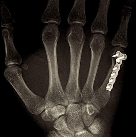 An In Depth Review Of Metacarpal Fractures If You Re Interested In