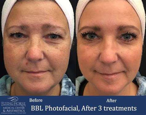 Laser Treatment Skin Resurfacing Microneedling And More At Fhmc