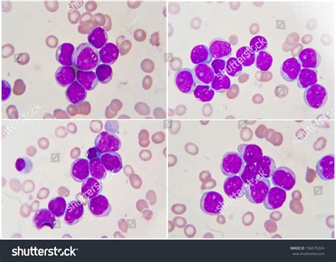 Unlike in the body, on this slide many red blood. Leukemia , Human Blood Cell Under Microscope 1000x Stock ...