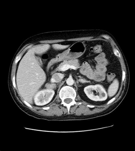 Metastatic Adenocarcinoma Of The Lung Image