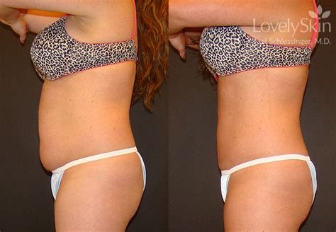 Omaha Cosmetic Surgery Tumescent Liposuction Skin Specialists Pc